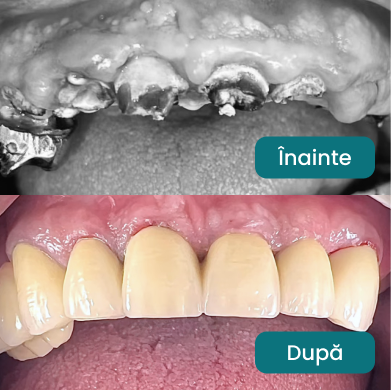 Tratament dentar înainte și după - Caz 3