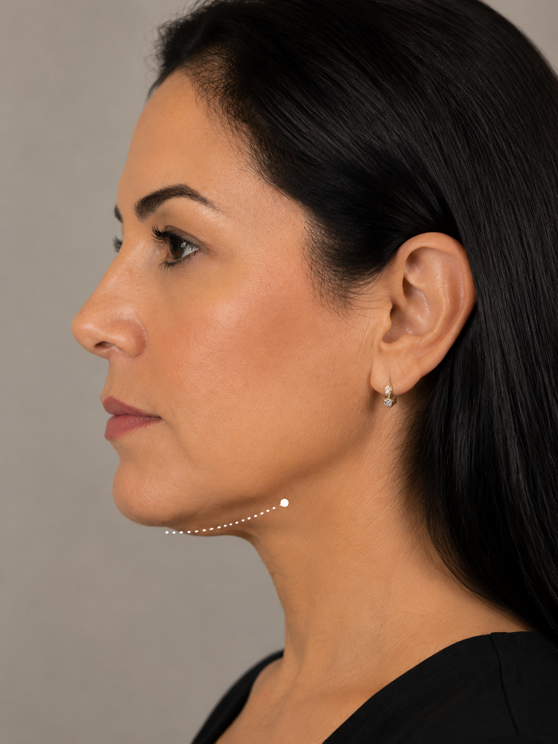 Resultado de Lipo de Papada — Dr. Antônio Tavares