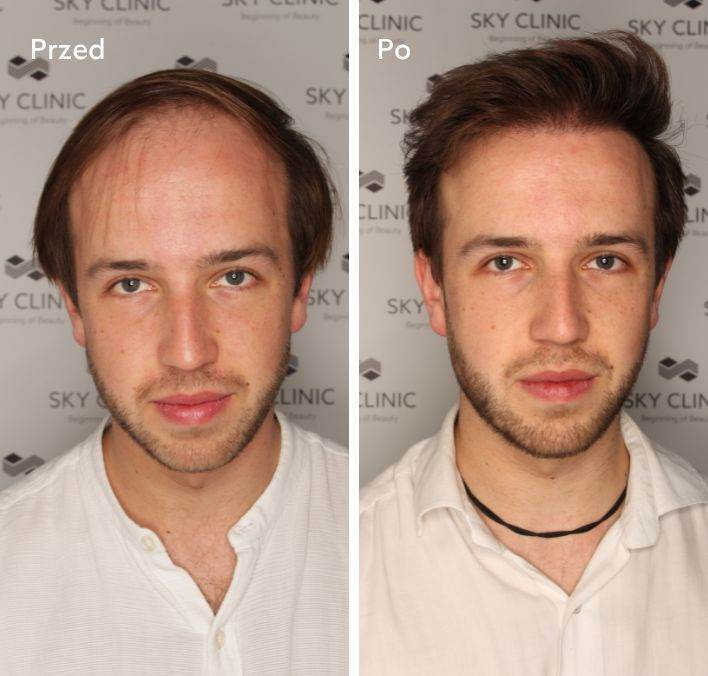 Odbudowa linii włosów