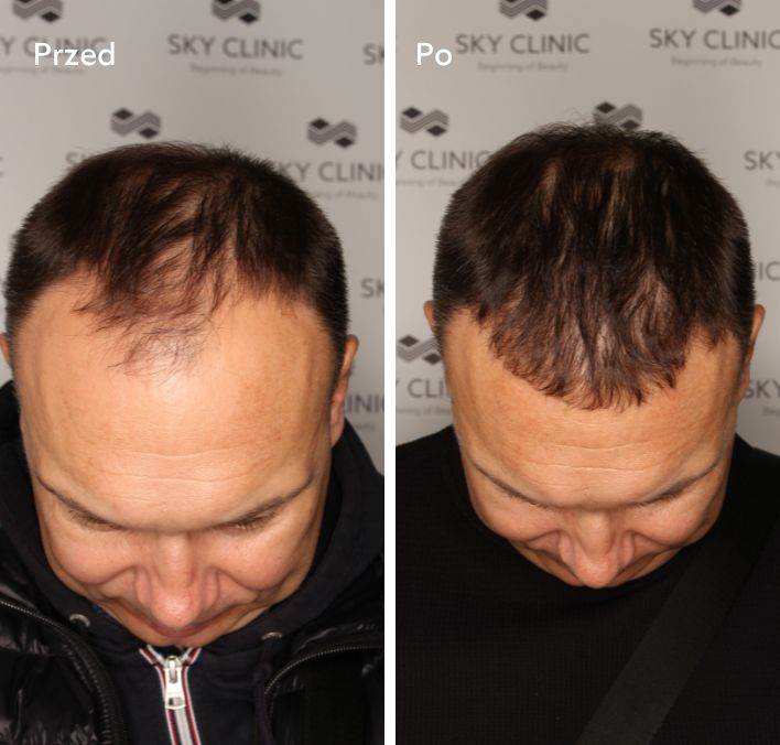 Zagęszczenie włosów