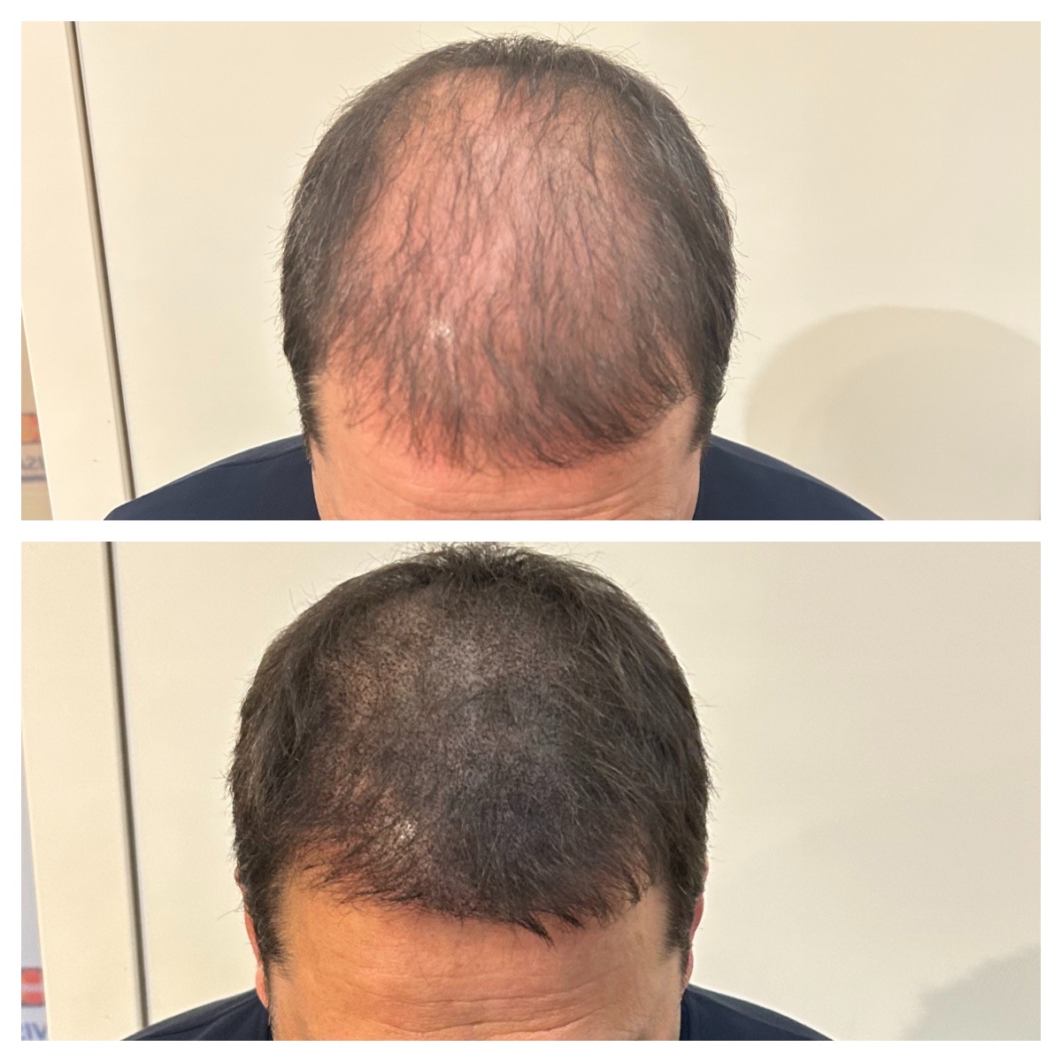 Voor en na resultaat na een haartransplantatie