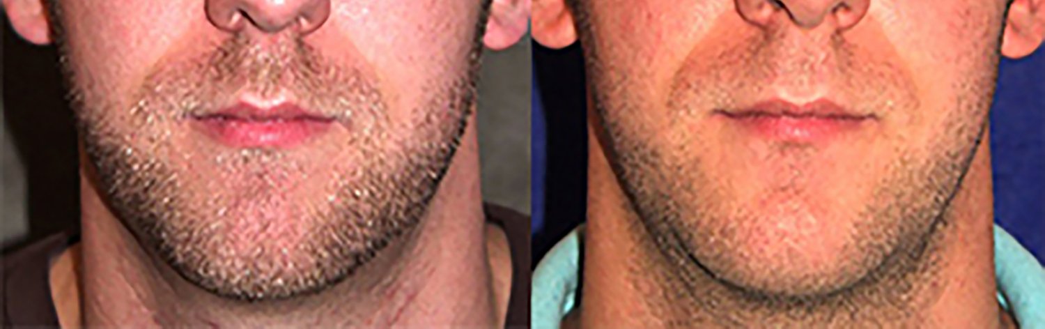 Dr. Kirwan patient result — Dr. Laurence Kirwan. Male patient, chin implant with rhinoplasty, 1 year post-op, front close-up. Before: left; After: right.