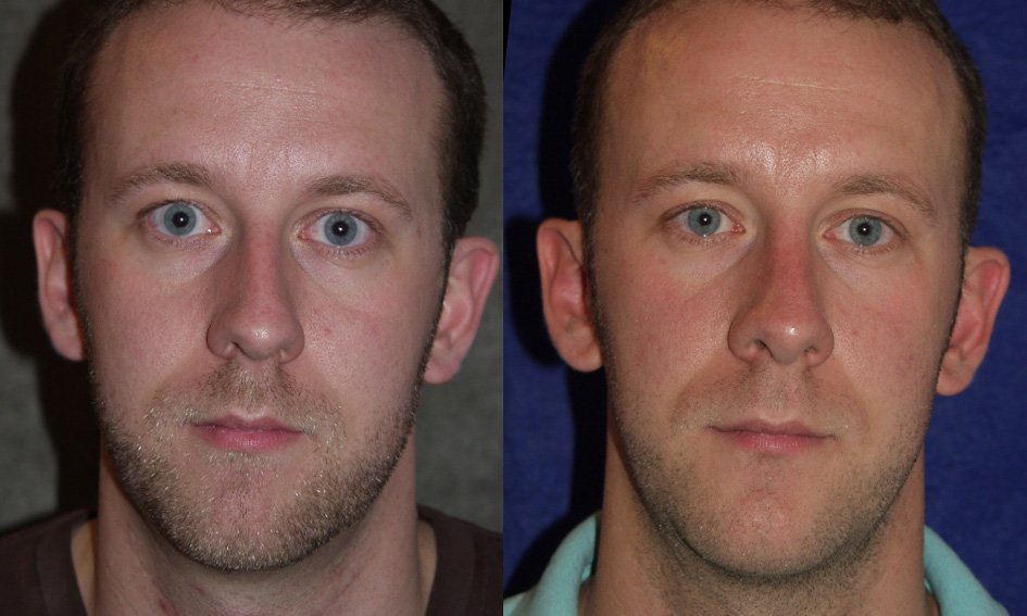 Rhinoplasty before and after photographs, case 7, with the before photograph on the left and the after photograph on the right