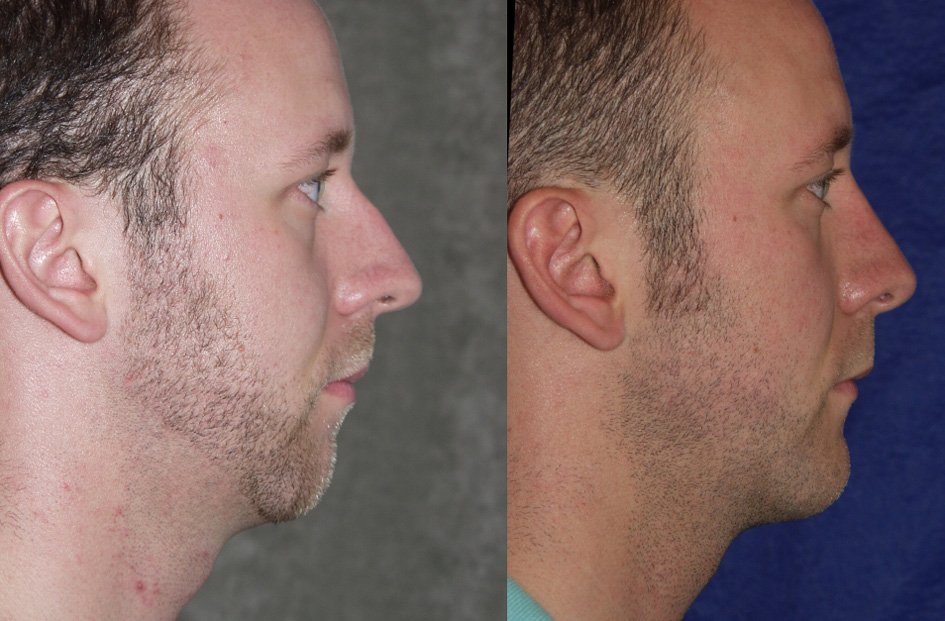 Rhinoplasty before and after photographs, case 8, with the before photograph on the left and the after photograph on the right