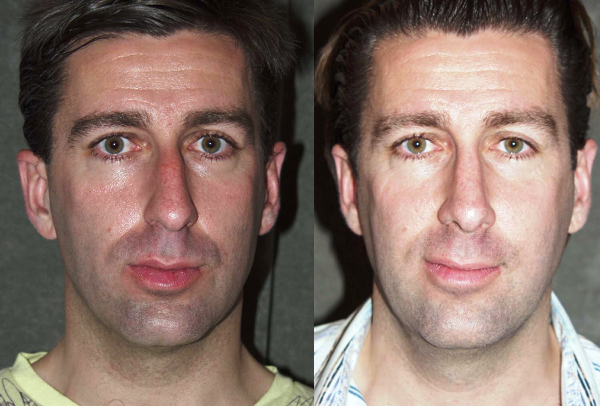 Rhinoplasty before and after photographs, case 3, with the before photograph on the left and the after photograph on the right