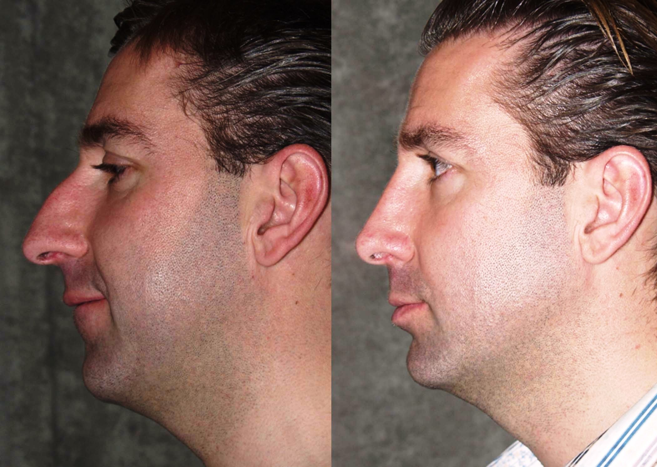 Rhinoplasty before and after photographs, case 4, with the before photograph on the left and the after photograph on the right