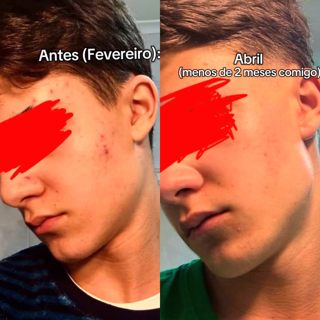 Transformacao da pele - antes e depois