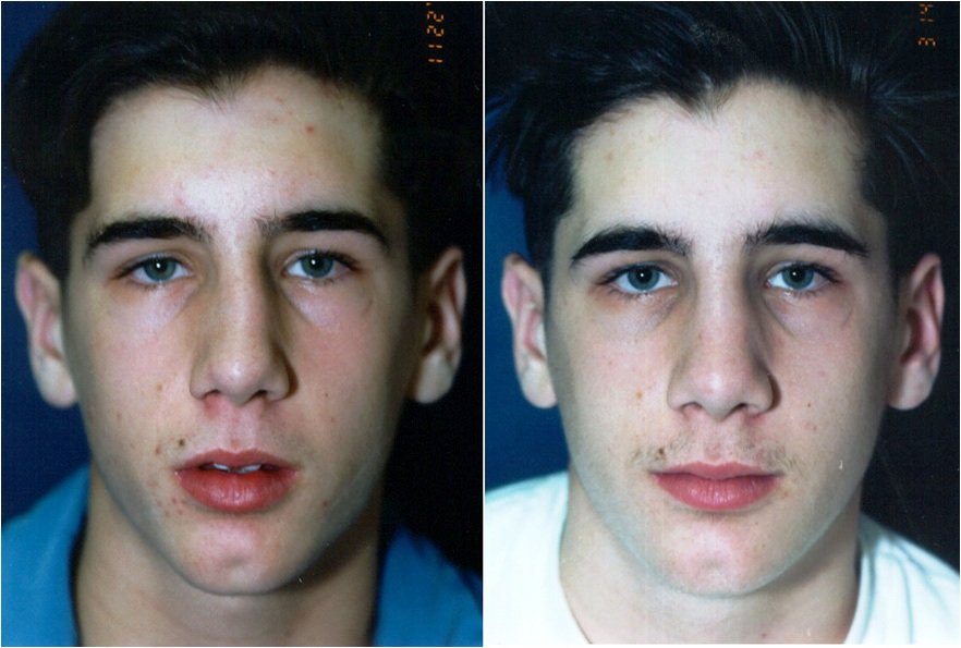 Rhinoplasty before and after photographs, case 12, with the before photograph on the left and the after photograph on the right