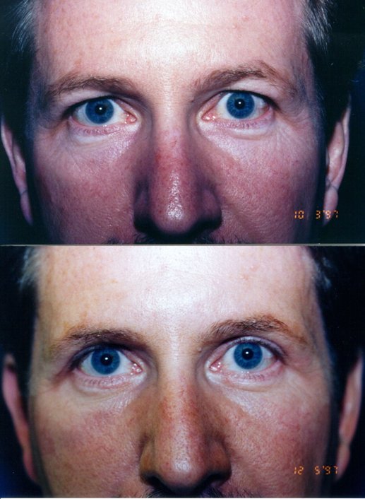 Blepharoplasty before and after photographs, case 9, with the before photograph on top and the after photograph below
