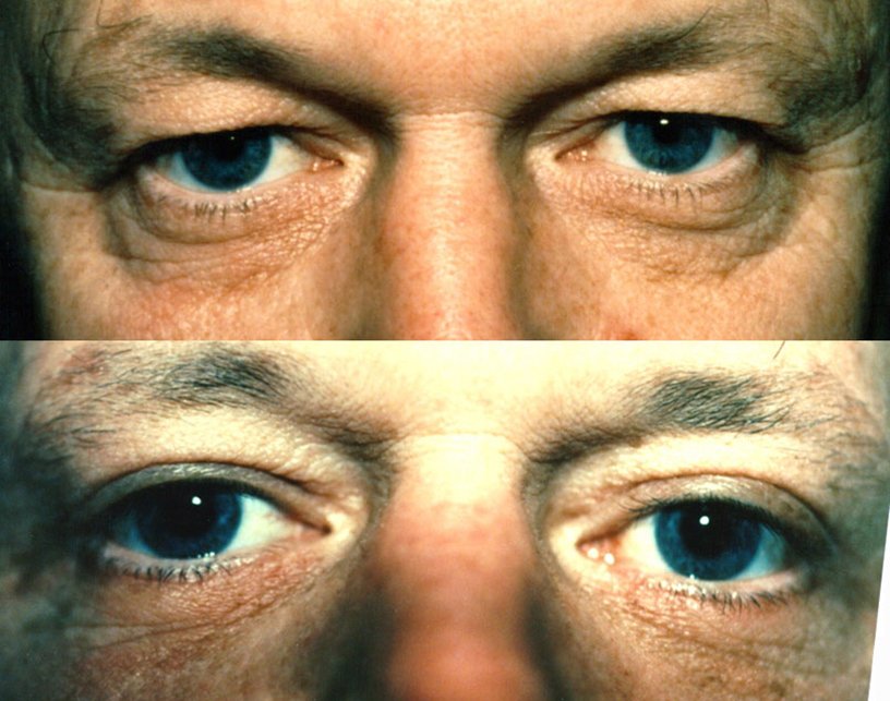 Blepharoplasty before and after photographs, case 8, with the before photograph on top and the after photograph below