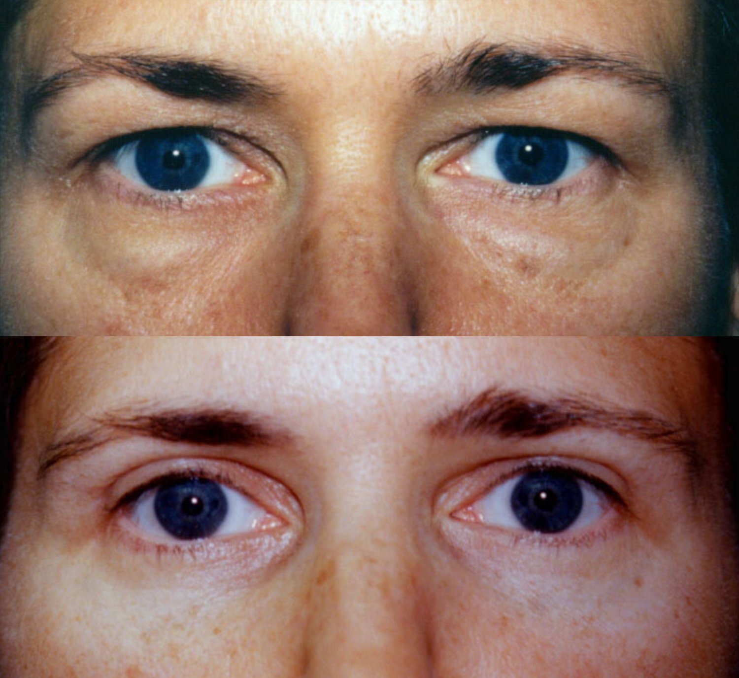 Blepharoplasty before and after photographs, case 3, with the before photograph on top and the after photograph below