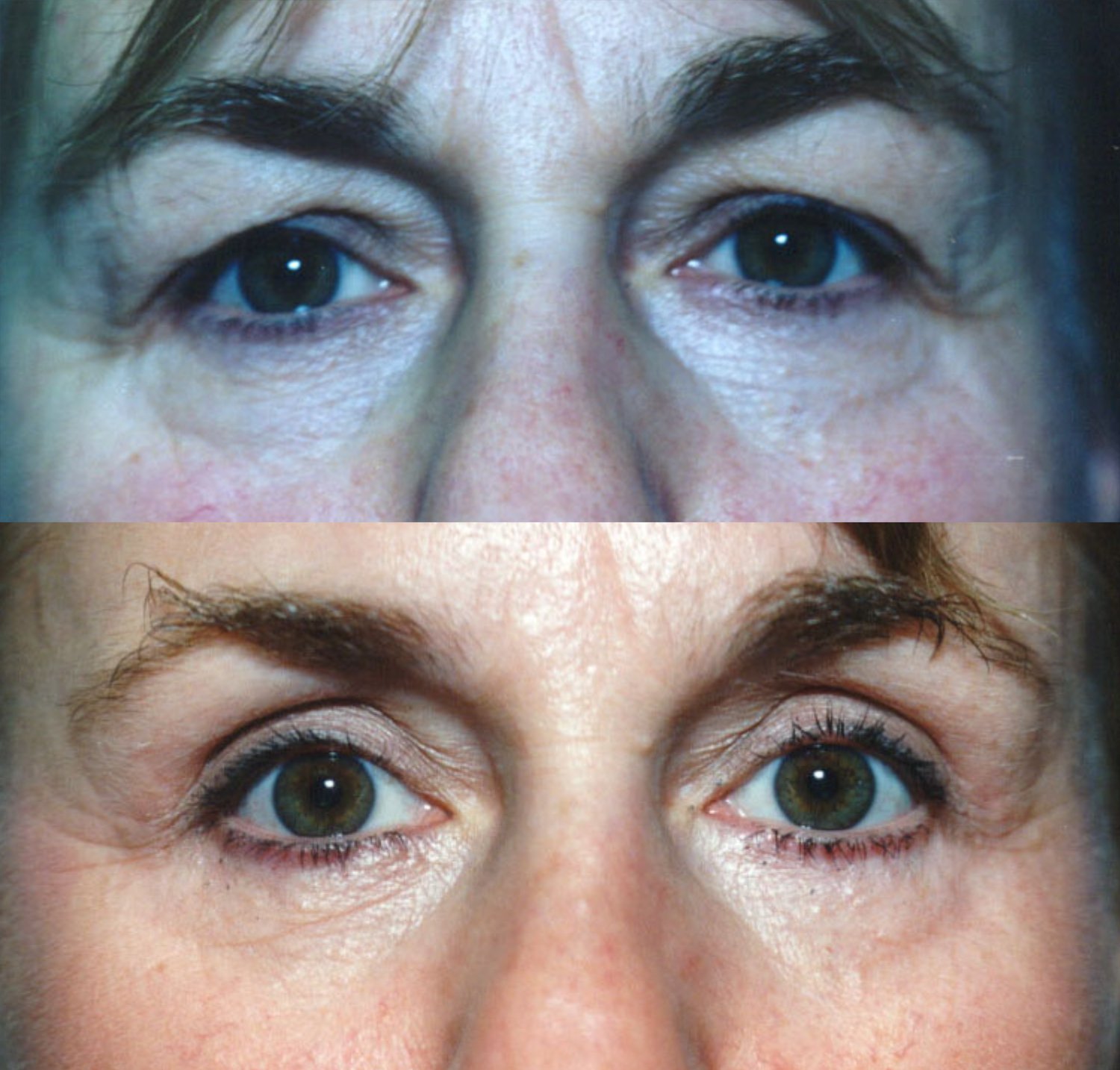 Blepharoplasty before and after photographs, case 4, with the before photograph on top and the after photograph below