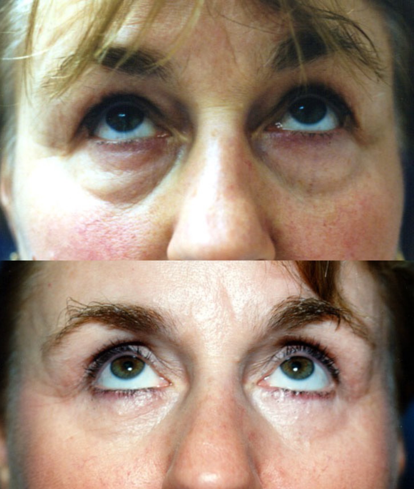 Blepharoplasty before and after photographs, case 5, with the before photograph on top and the after photograph below