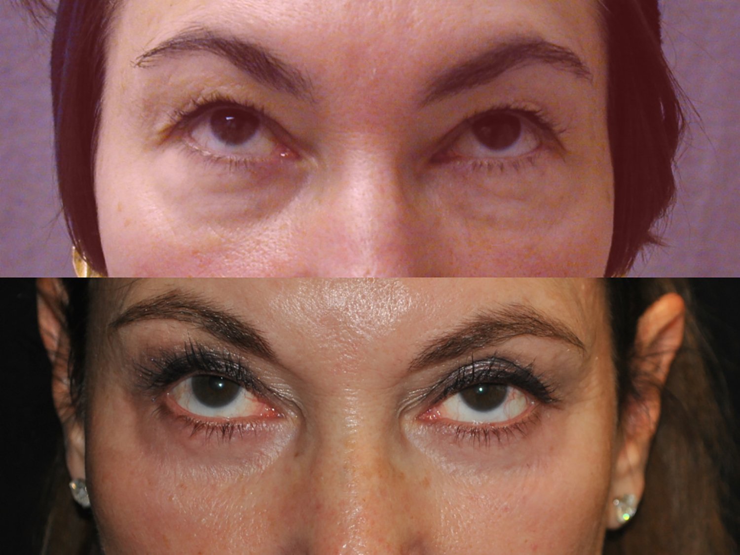 Blepharoplasty before and after photographs, case 6, with the before photograph on top and the after photograph below