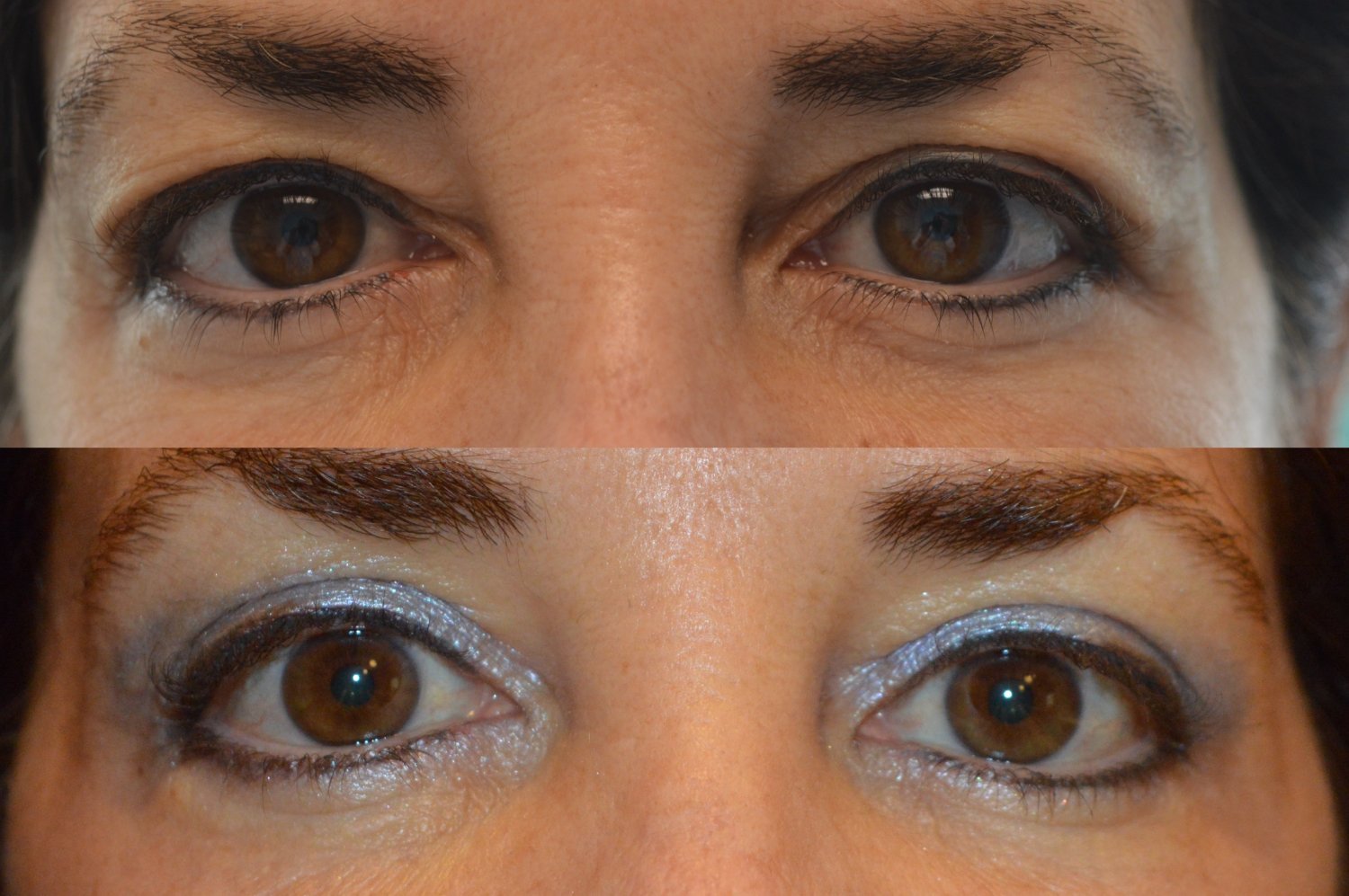 Blepharoplasty before and after photographs, case 1, with the before photograph on top and the after photograph below