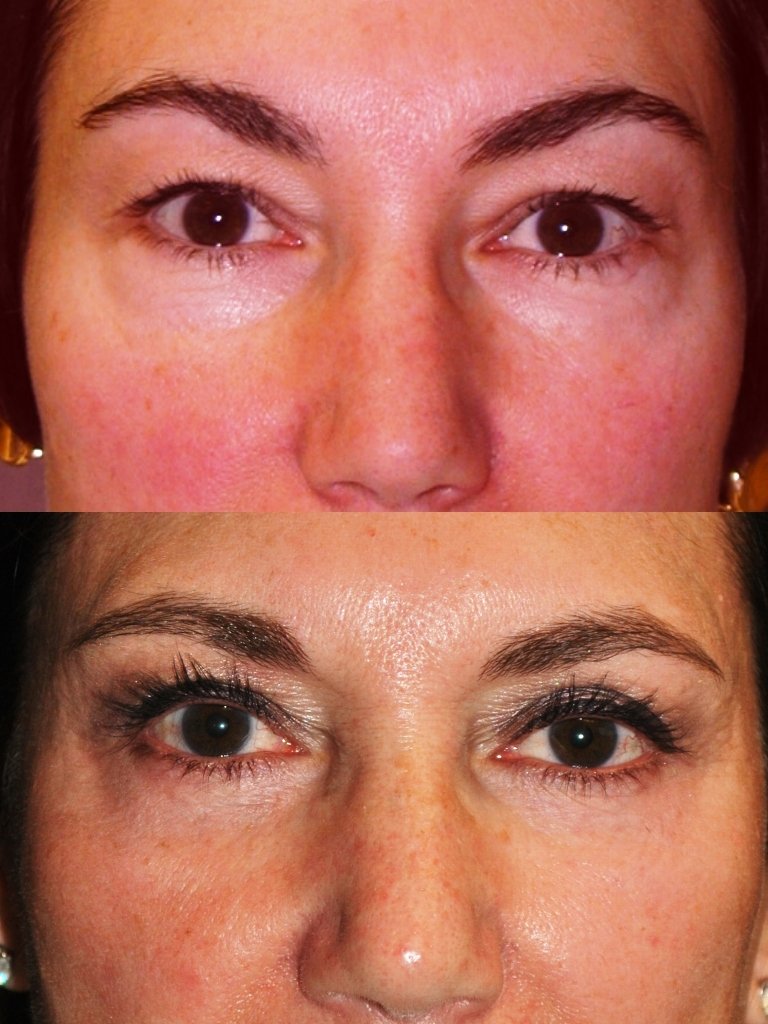Blepharoplasty before and after photographs, case 7, with the before photograph on top and the after photograph below